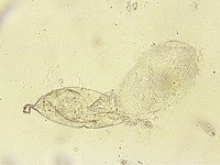 Schistosoma haematobium